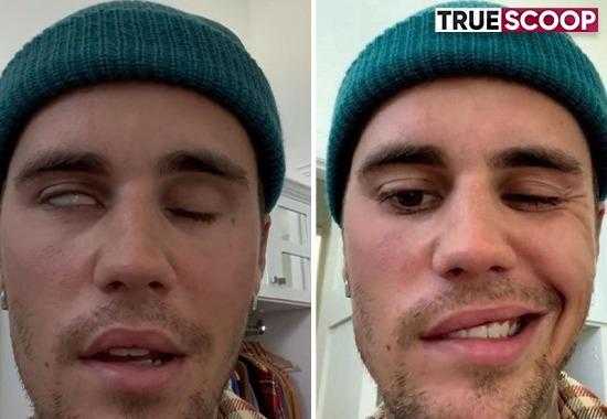 Justin-Bieber right-side-of-face-paralyzed Ramsay-Hunt-Syndrome