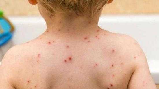 Monkeypox -What-is-Monkeypox -Symptoms-of-Monkeypox