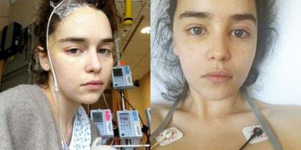 Emilia-Clarke-Aneurismas -Emilia-Clarke-Aneurysm -What-is-aneurysm