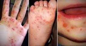 Hand-Foot-Mouth-Viral HFM-disease hand-rashes