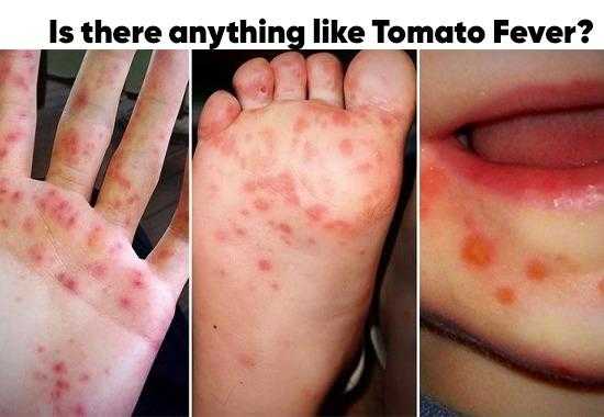 Tomato-Fever HFMD Hand-Foot-Mouth-Disease